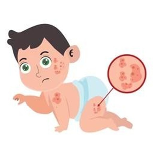 Baby with scattered red spots on face, arms, and diaper area, suggesting a chickenpox rash in a crawling pose.