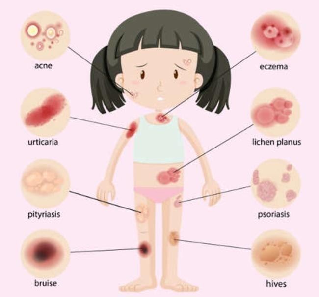 Illustration of a girl with eight labeled skin conditions around her body: acne, eczema, urticaria, lichen planus, pityriasis, psoriasis, hives, and bruises/bruise.