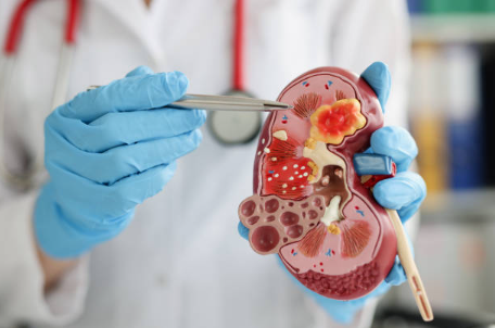 Picture2 - Sparsh Hospital - Sparsh Hospital Gloved medical professional holding a detailed kidney model and pointing at it with a metal pointer to show internal anatomy.