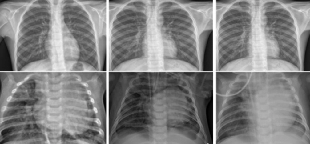 Six-panel montage of pediatric chest X-ray images showing the lungs, heart, and thoracic structures from different angles/views (top and bottom rows).