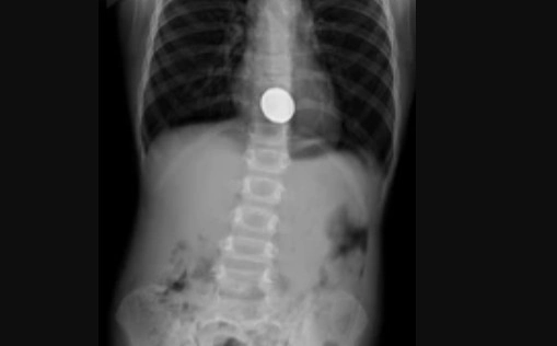 Pediatric abdominal and chest X-ray showing spinal hardware along the midline and a circular radiopaque device over the upper abdomen.
