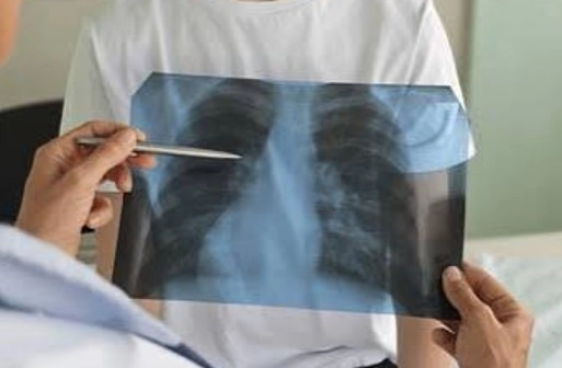 Healthcare professional uses a pointer to explain a chest X-ray held by a patient, showing the lungs in the image.