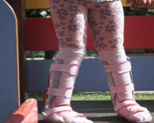 Young child wearing pink floral leggings and medical leg braces standing on a playground surface.